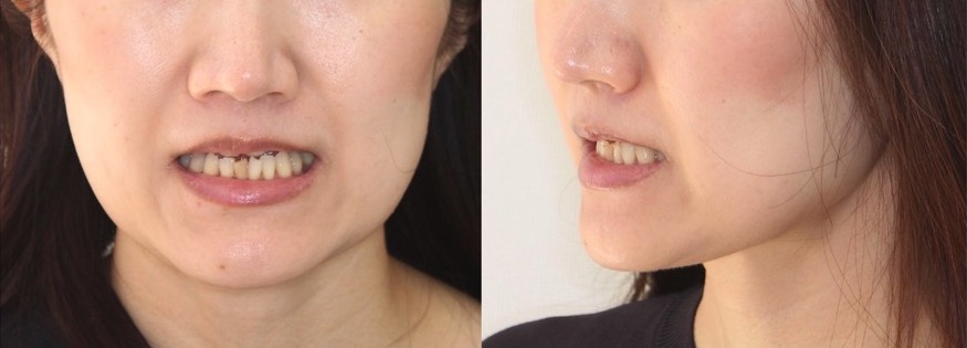 矯正治療例・40歳女性・マウスピース型矯正装置