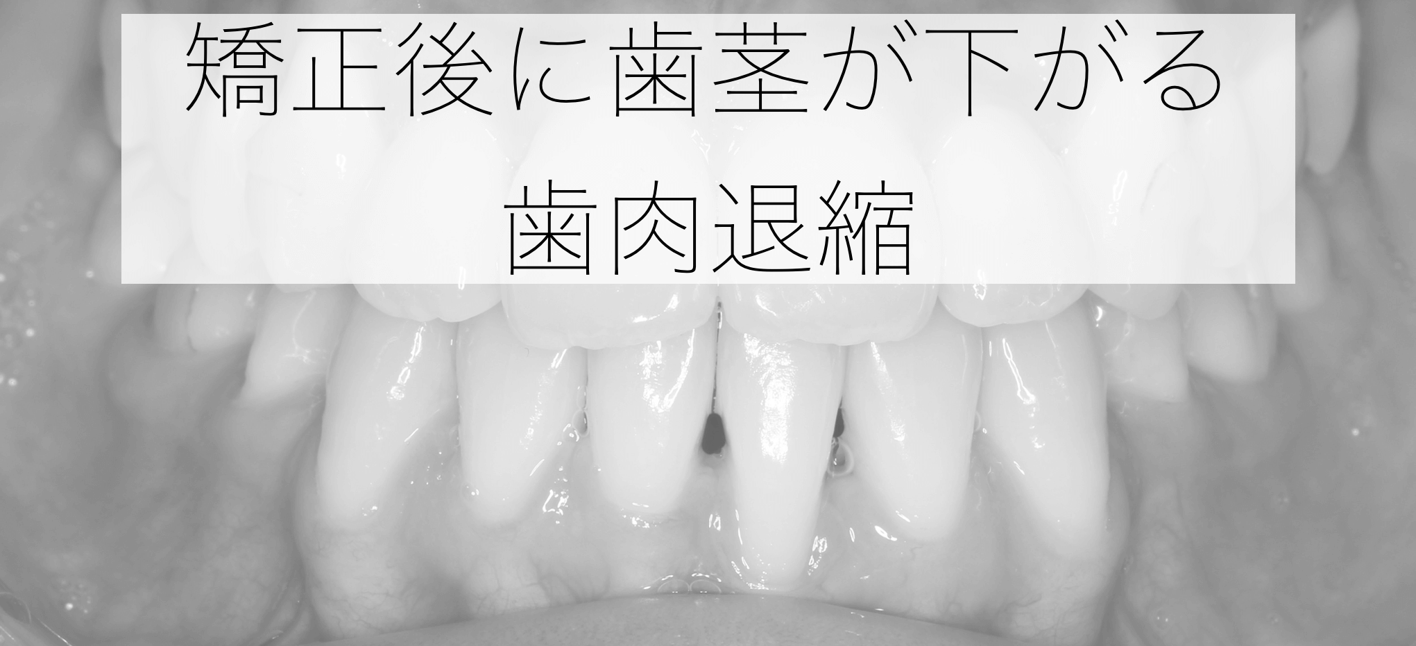 【副作用】矯正治療による歯肉退縮
