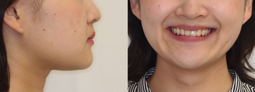 矯正治療例・20代女性・先天性欠損2歯・下5欠損