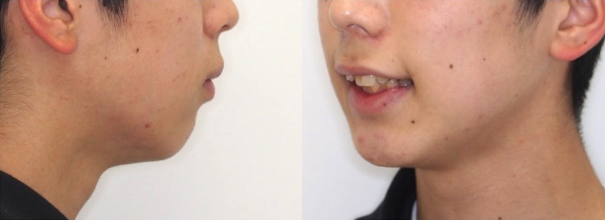 矯正治療例・大学生男性・八重歯・マウスピース型装置・抜歯