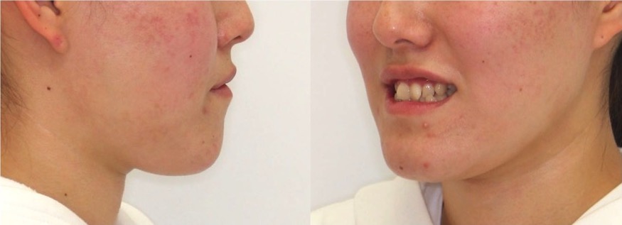 矯正治療例・大学生女性・八重歯・マウスピース型装置・非抜歯