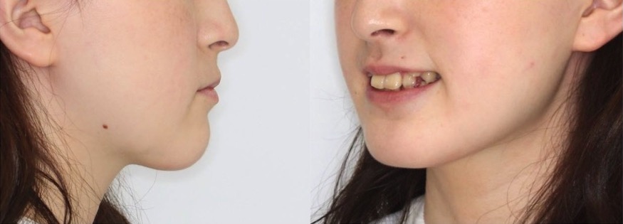 矯正治療例・高校生女性・八重歯・マウスピース型装置・抜歯