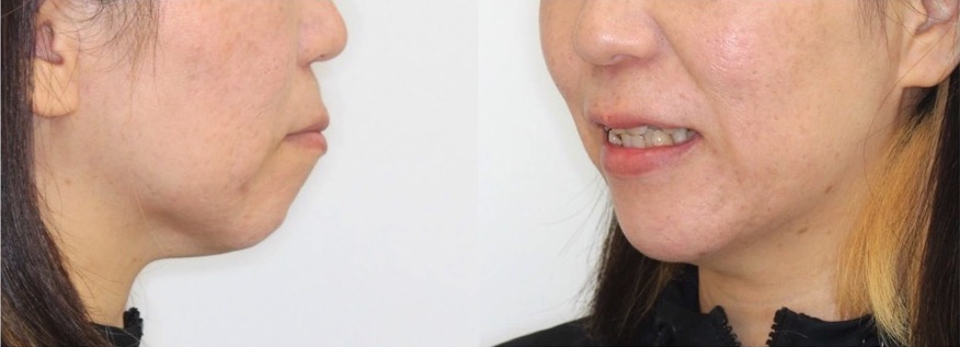 矯正治療例・43歳女性・唇側矯正装置・抜歯