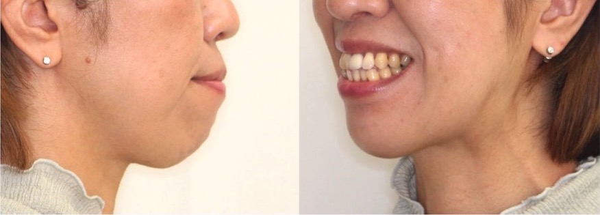 矯正治療例・46歳女性・唇側矯正装置・抜歯