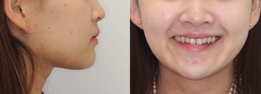 矯正治療例・20代女性・先天性欠損2歯・下5欠損