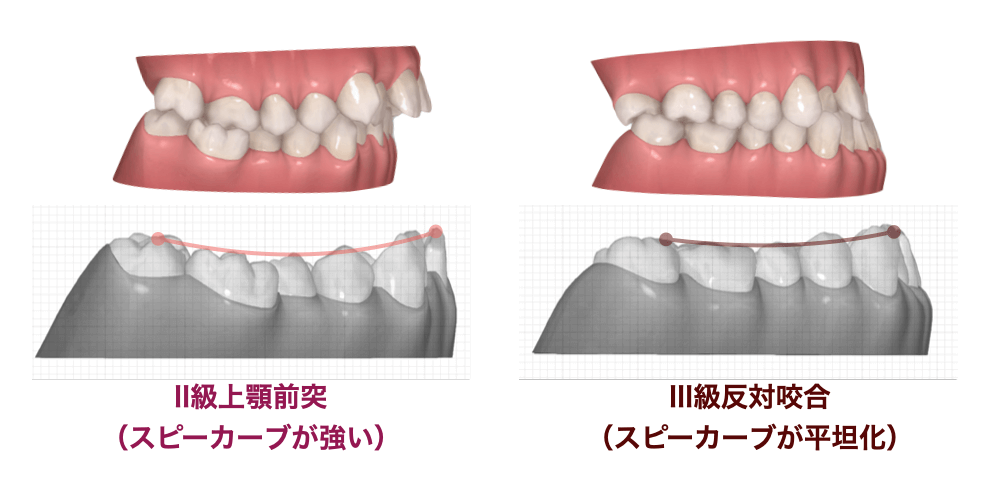 スピーカーブの量のちがい