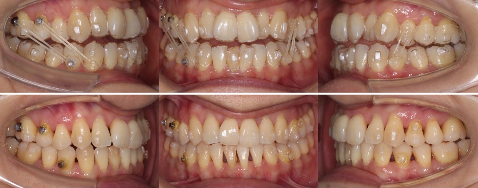 矯正治療例・40歳女性・マウスピース型矯正装置