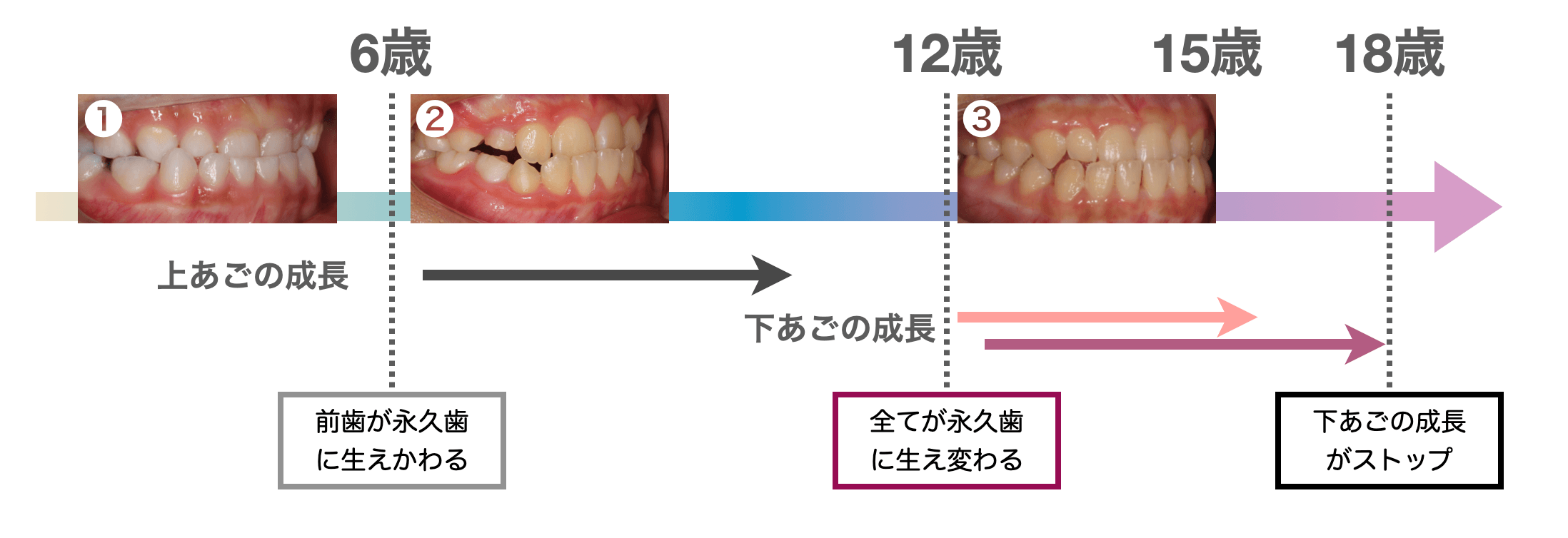 3つの受け口の治療開始時期