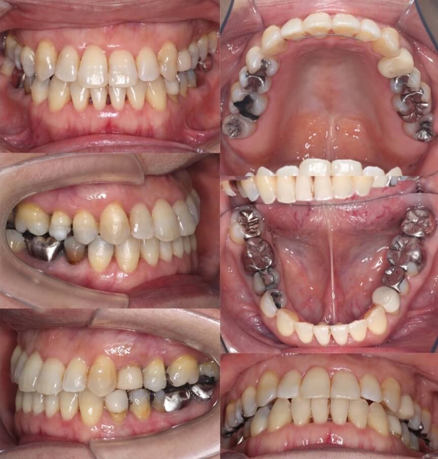 ミドルエイジ(40代・50代)の矯正治療症例写真集-アフター歯並び