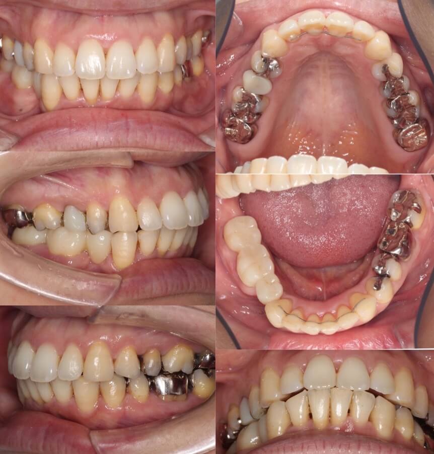 ミドルエイジ(40代・50代)の矯正治療症例写真集-アフター歯並び