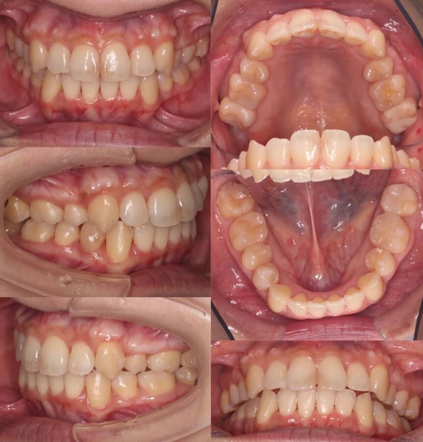 ミドルエイジ(40代・50代)の矯正治療症例写真集-アフター歯並び