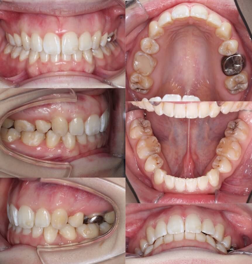 上下顎前突【口ゴボ】矯正治療症例写真集-ビフォー歯並び