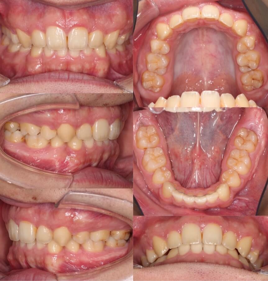 前歯の深噛み【過蓋咬合】矯正治療症例写真集-アフター歯並び