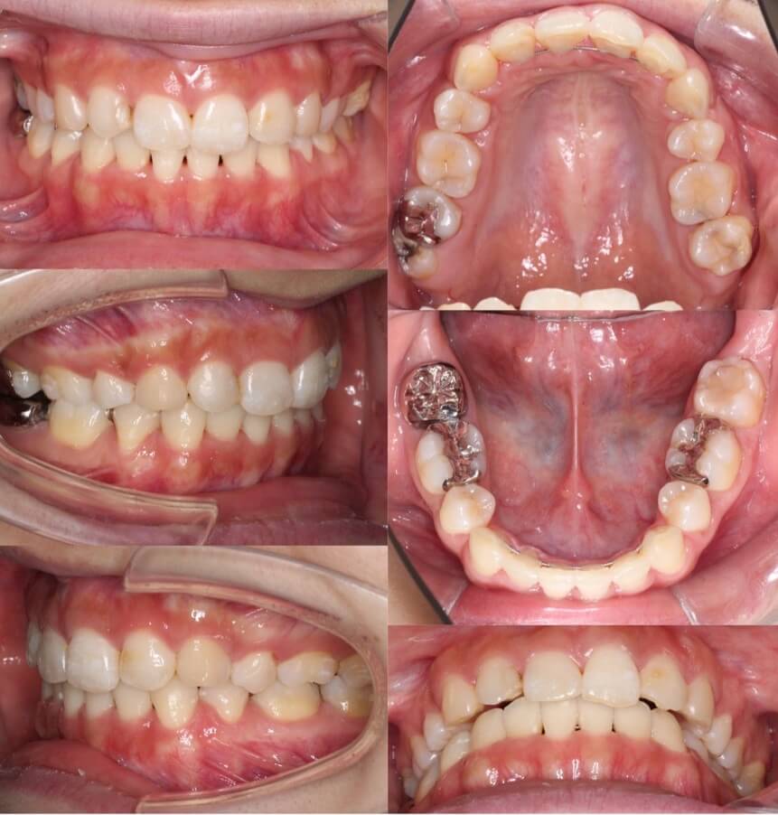 前歯の深噛み【過蓋咬合】矯正治療症例写真集-アフター歯並び