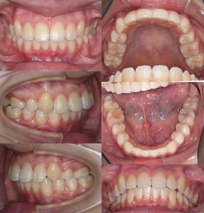 でこぼこ・ガタガタ【叢生】矯正治療症例写真集-アフター歯並び