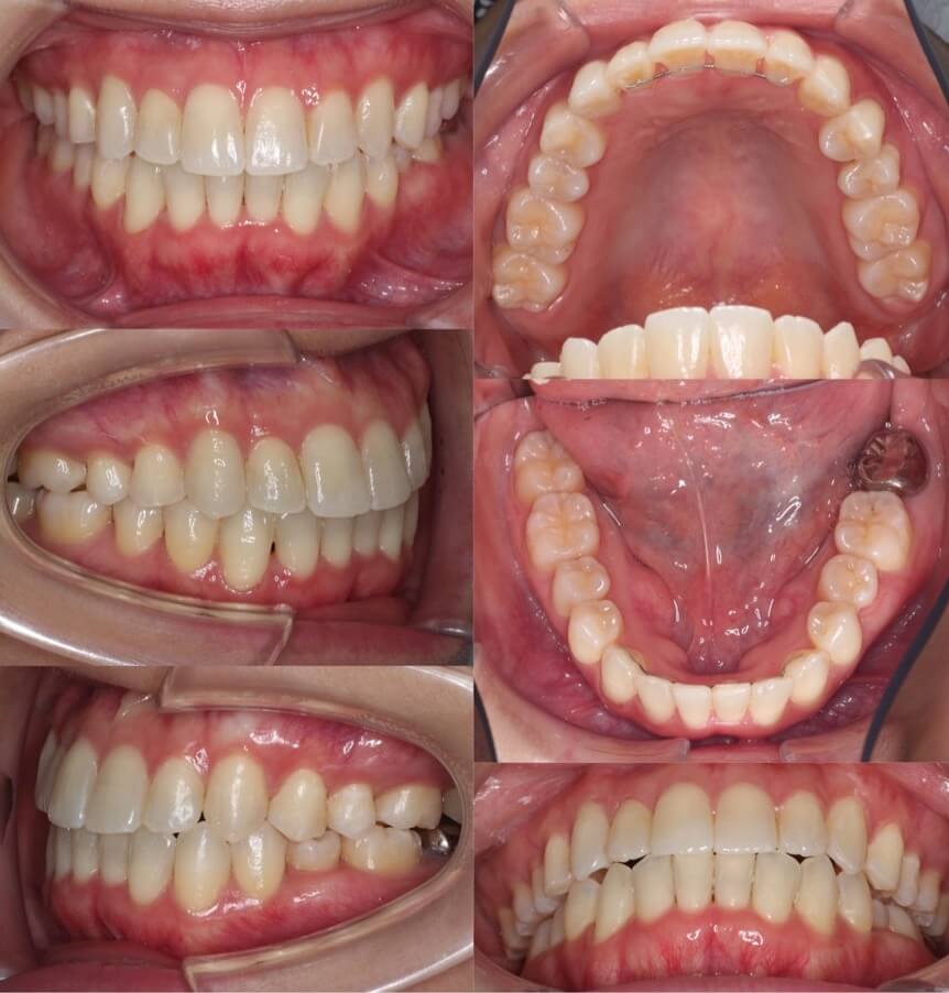 ミドルエイジ(40代・50代)の矯正治療症例写真集-アフター歯並び