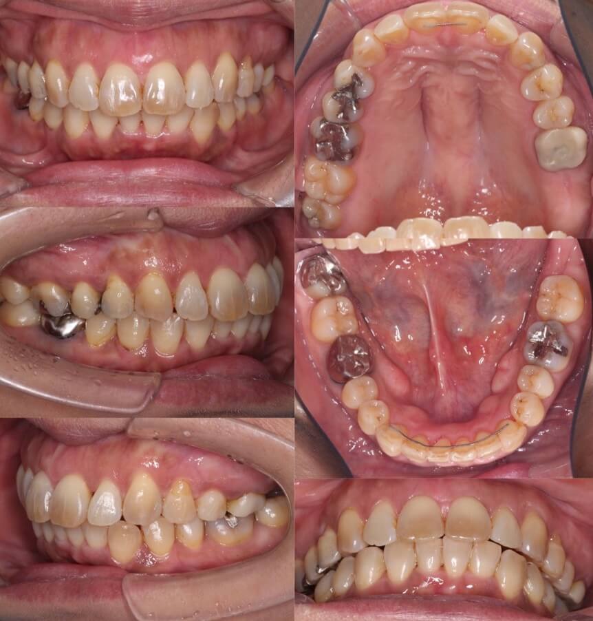 ミドルエイジ(40代・50代)の矯正治療症例写真集-アフター歯並び