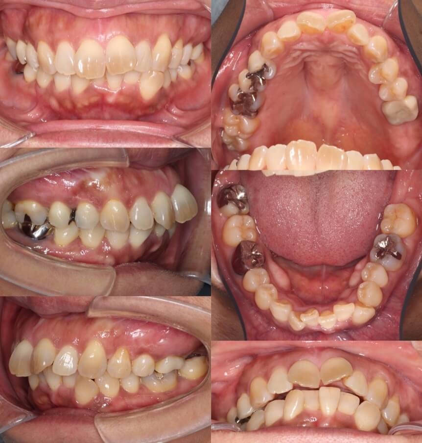 ミドルエイジ(40代・50代)の矯正治療症例写真集-ビフォー歯並び