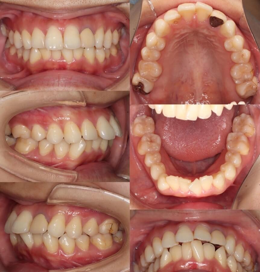 上下顎前突【口ゴボ】矯正治療症例写真集-ビフォー歯並び