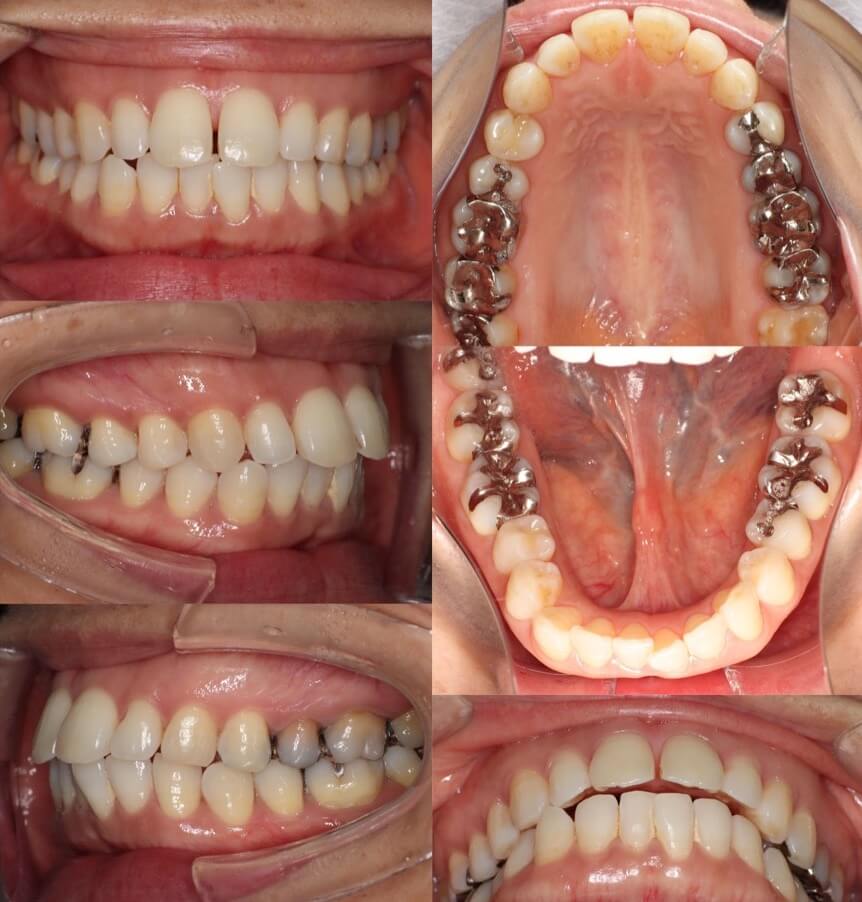 ミドルエイジ(40代・50代)の矯正治療症例写真集-ビフォー歯並び