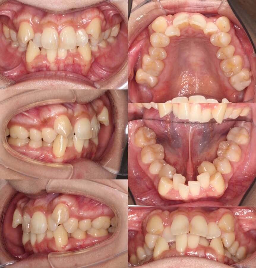 ミドルエイジ(40代・50代)の矯正治療症例写真集-ビフォー歯並び