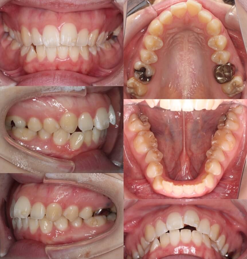 上下顎前突【口ゴボ】矯正治療症例写真集-ビフォー歯並び