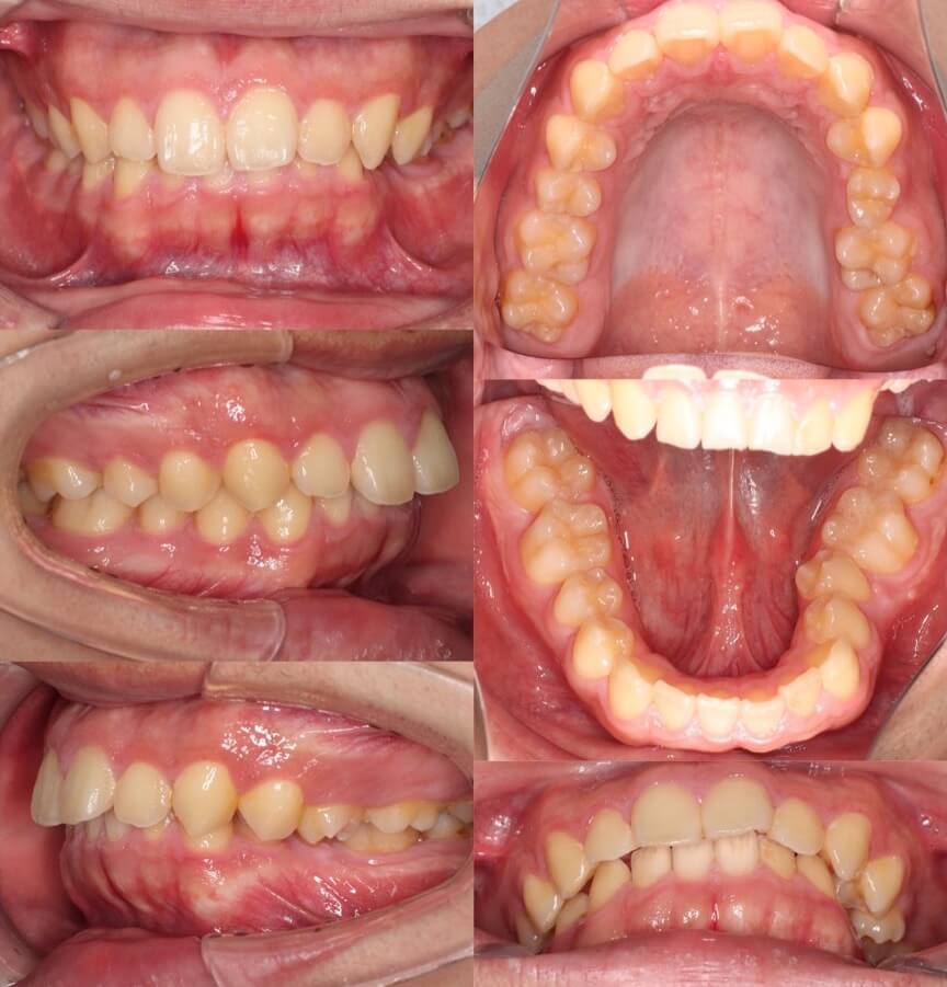 前歯の深噛み【過蓋咬合】矯正治療症例写真集-ビフォー歯並び