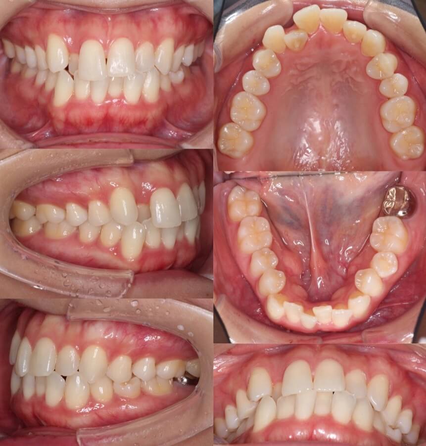 ミドルエイジ(40代・50代)の矯正治療症例写真集-ビフォー歯並び