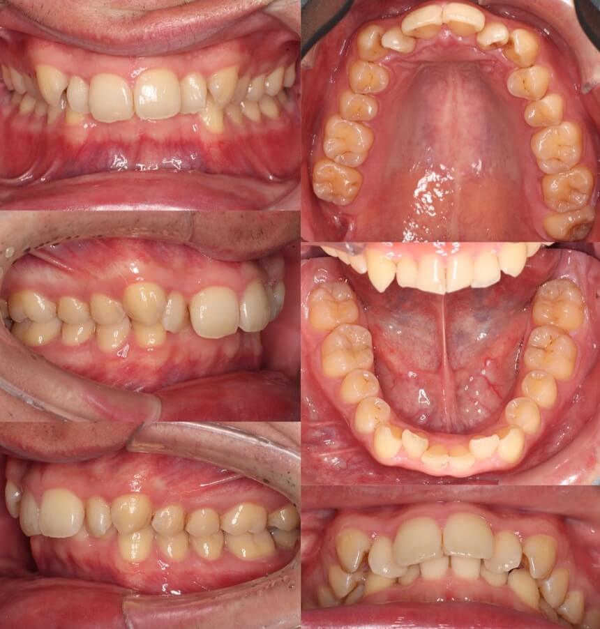 前歯の深噛み【過蓋咬合】矯正治療症例写真集-ビフォー歯並び