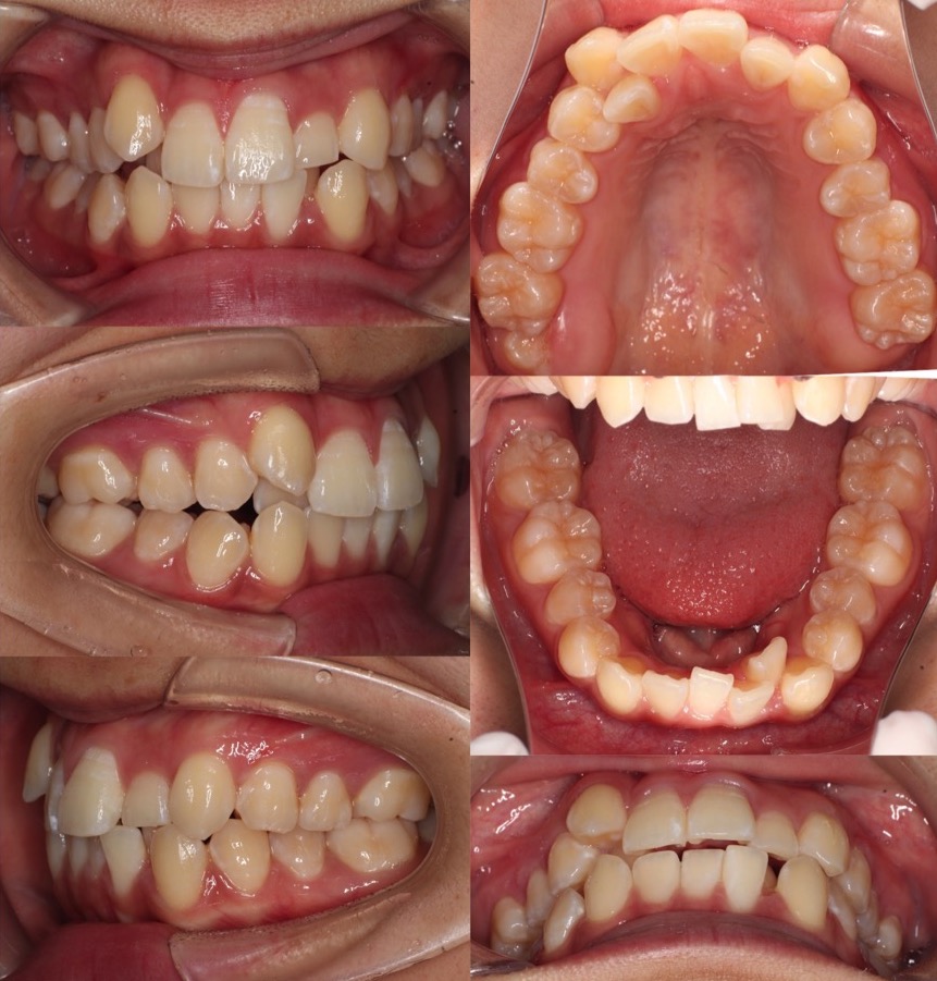 でこぼこ・ガタガタ【叢生】矯正治療症例写真集-ビフォー歯並び