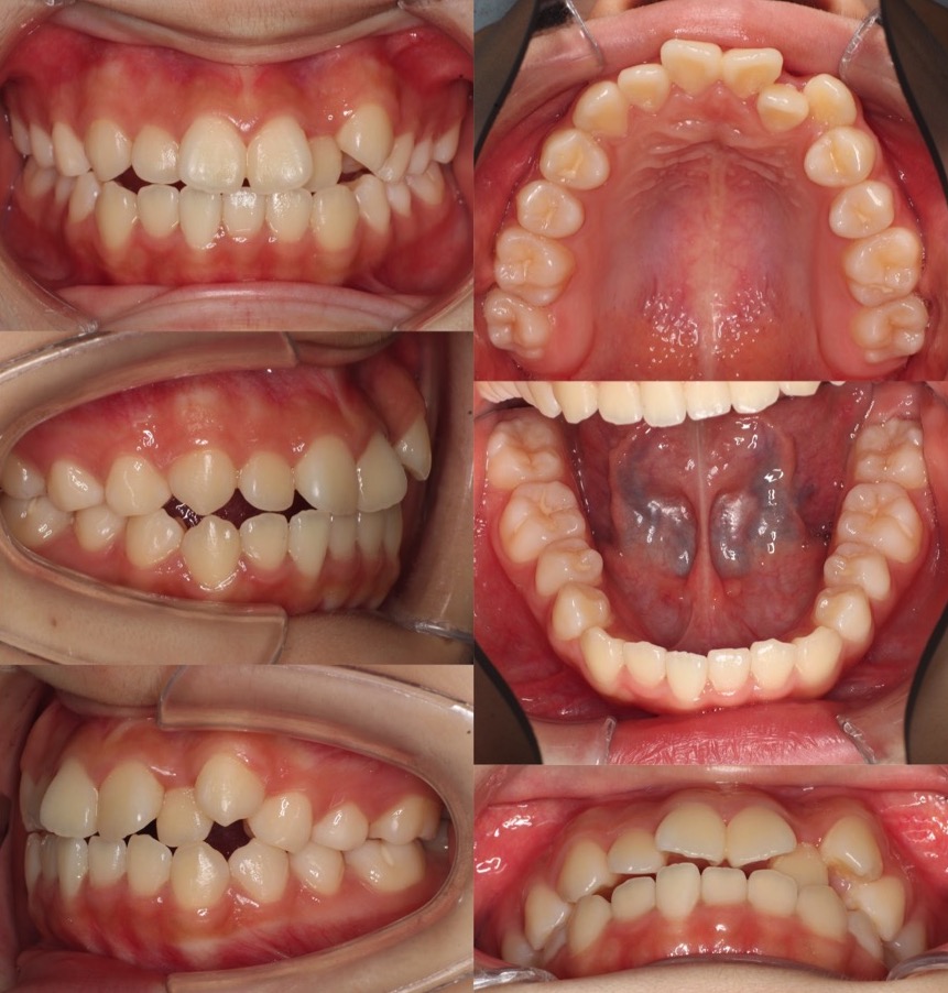 でこぼこ・ガタガタ【叢生】矯正治療症例写真集-ビフォー歯並び