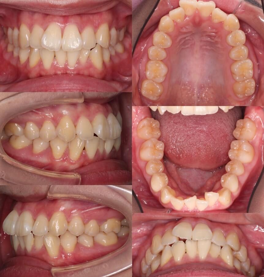 でこぼこ・ガタガタ【叢生】矯正治療症例写真集-ビフォー歯並び