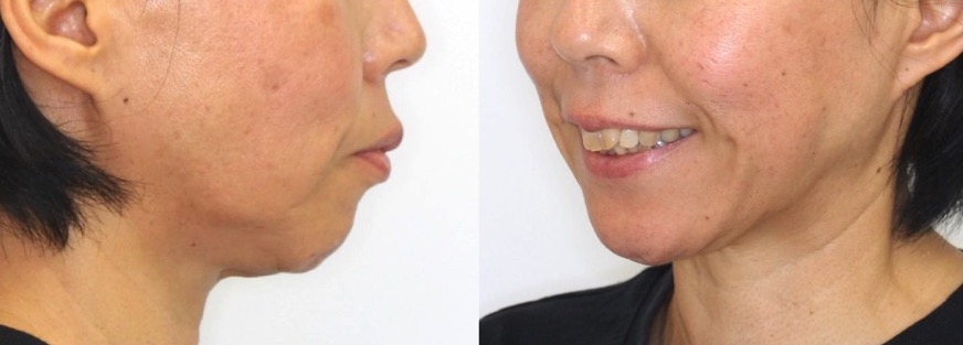 ミドルエイジ(40代・50代)の矯正治療症例写真集-ビフォー顔