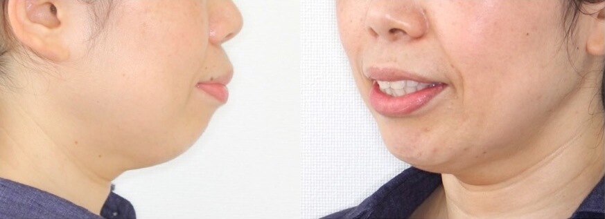 ミドルエイジ(40代・50代)の矯正治療症例写真集-ビフォー顔