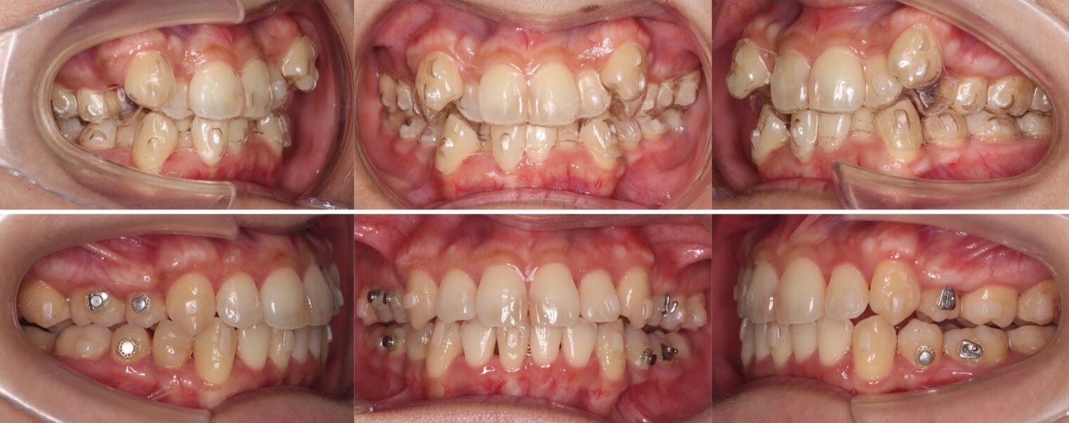 ミドルエイジ(40代・50代)の矯正治療症例写真集-治療経過