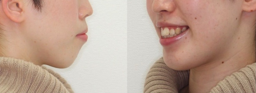 上下顎前突【口ゴボ】矯正治療症例写真集-ビフォー顔