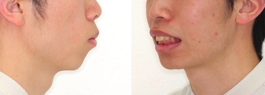 前歯の深噛み【過蓋咬合】矯正治療症例写真集-ビフォー顔