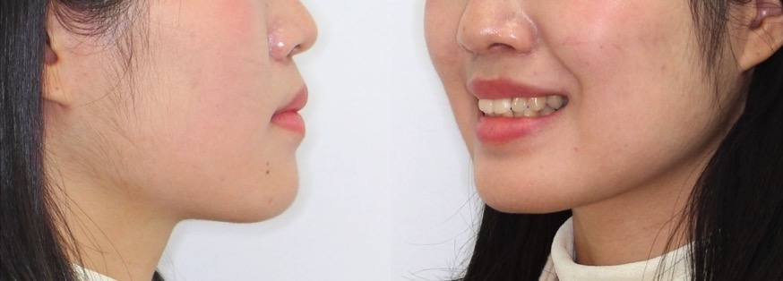 でこぼこ・ガタガタ【叢生】矯正治療症例写真集-ビフォー顔