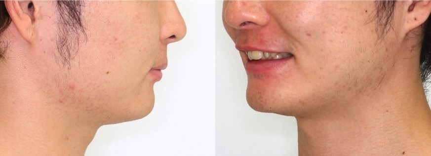 前歯の深噛み【過蓋咬合】矯正治療症例写真集-ビフォー顔