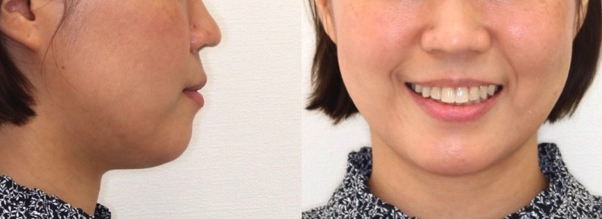 ミドルエイジ(40代・50代)の矯正治療症例写真集-アフター顔