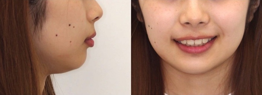 でこぼこ・ガタガタ【叢生】矯正治療症例写真集-アフター顔