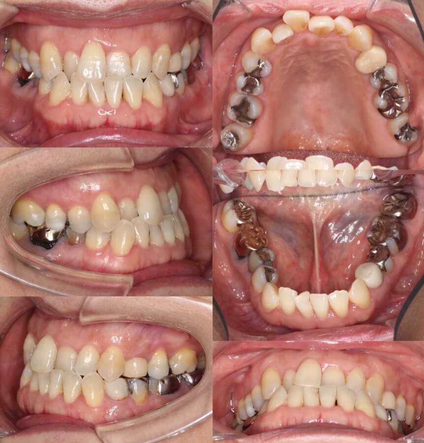 ミドルエイジ(40代・50代)の矯正治療症例写真集-ビフォー歯並び