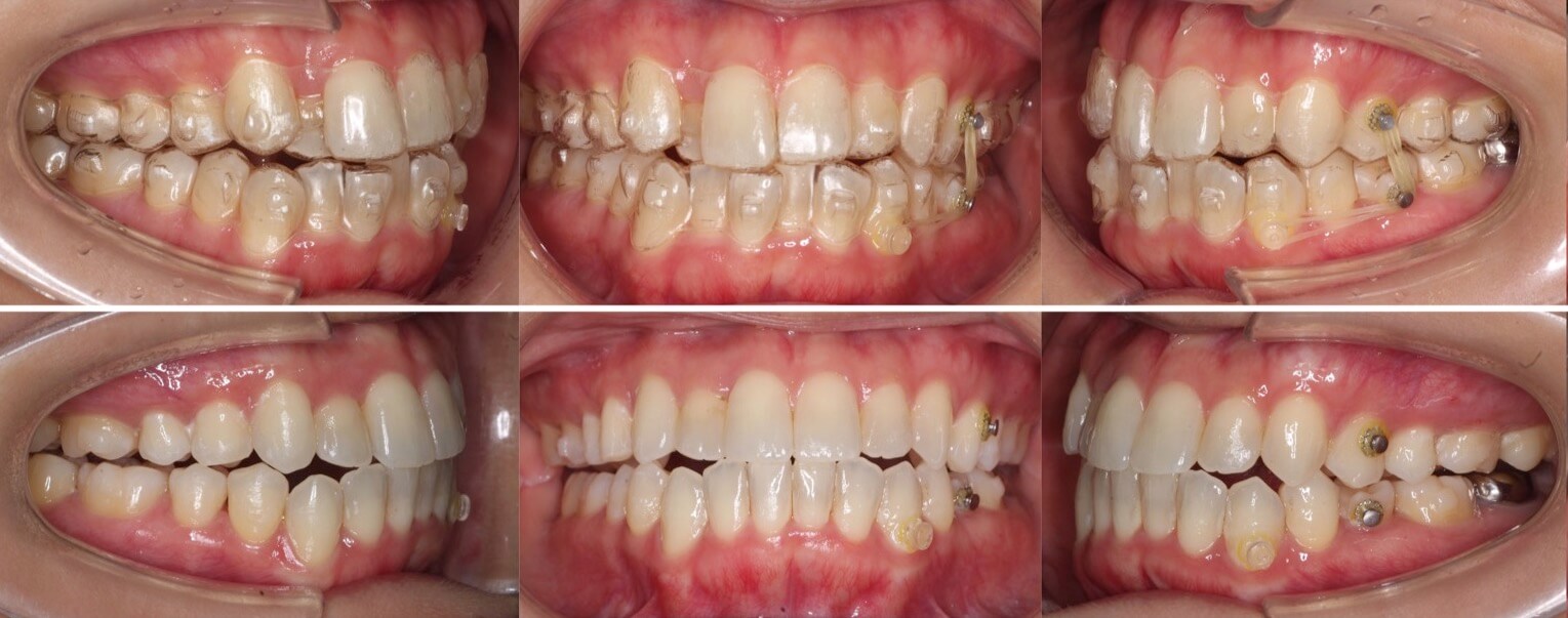 ミドルエイジ(40代・50代)の矯正治療症例写真集-治療経過