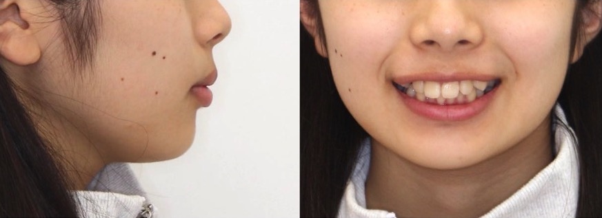 でこぼこ・ガタガタ【叢生】矯正治療症例写真集-ビフォー顔