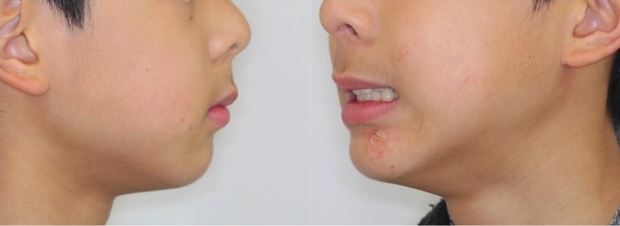 でこぼこ・ガタガタ【叢生】矯正治療症例写真集-アフター顔