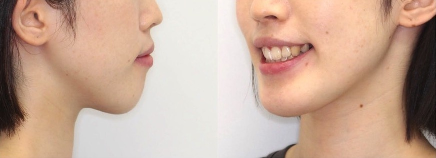上下顎前突【口ゴボ】矯正治療症例写真集-アフター顔