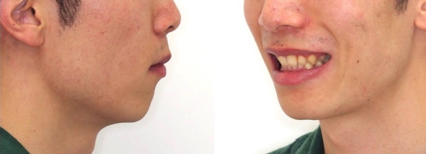 前歯の深噛み【過蓋咬合】矯正治療症例写真集-アフター顔