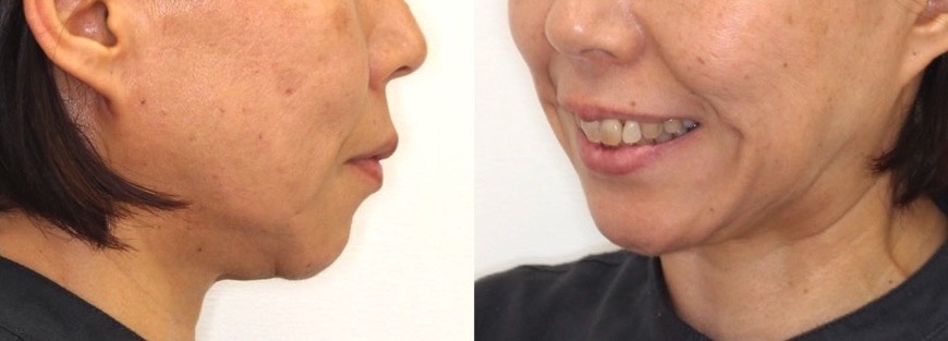 ミドルエイジ(40代・50代)の矯正治療症例写真集-アフター顔