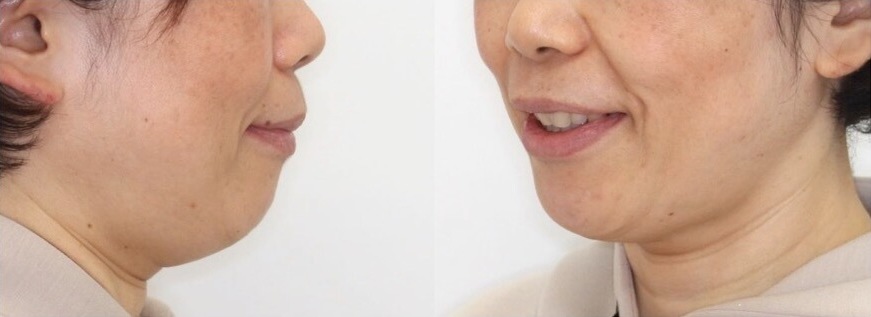ミドルエイジ(40代・50代)の矯正治療症例写真集-アフター顔