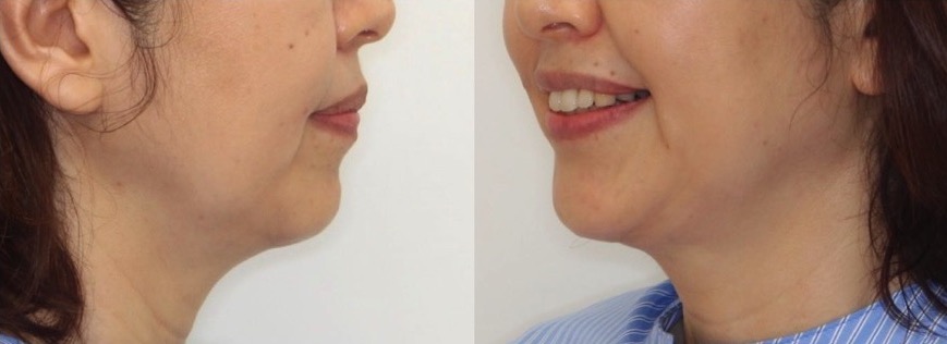 ミドルエイジ(40代・50代)の矯正治療症例写真集-アフター顔